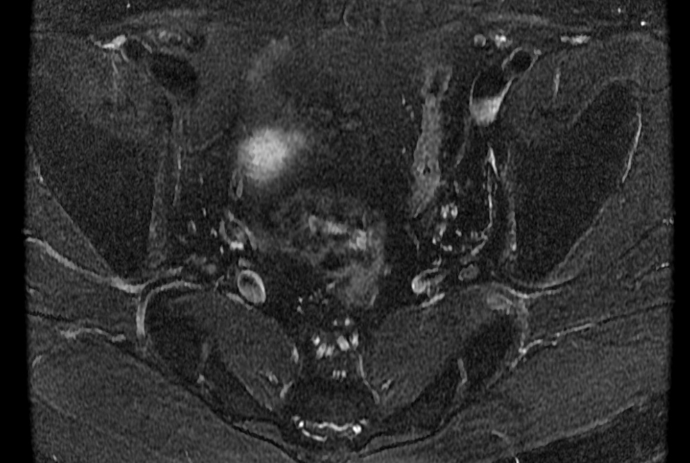 Figure 4 for case Bilateral accessory piriformis muscles